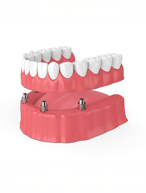 Model of an All on 4 denture being placed onto four dental implants