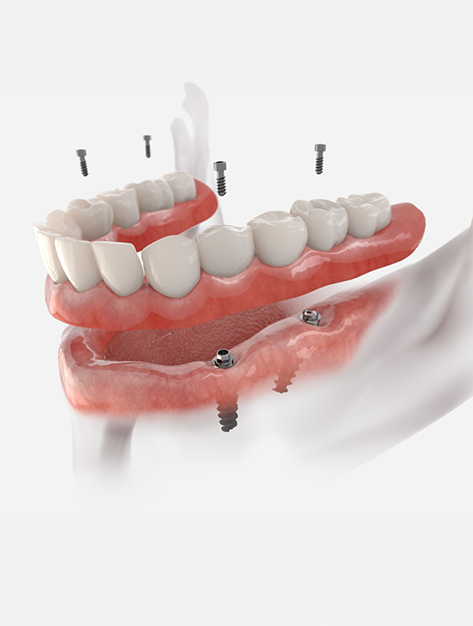 Illustration of a full denture being secured onto four dental implants in the lower jaw