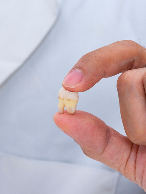 Close up of an oral surgeon holding an extracted wisdom tooth