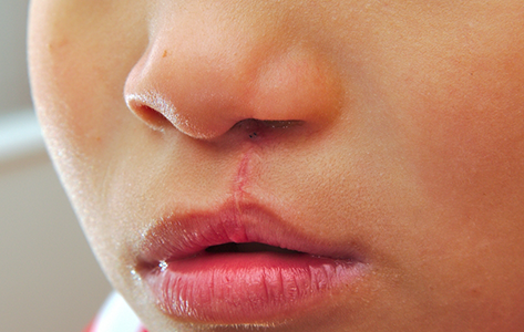 Close up of a person with a cleft lip