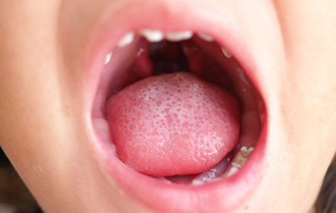 Close up of a wide open mouth with a cleft palate