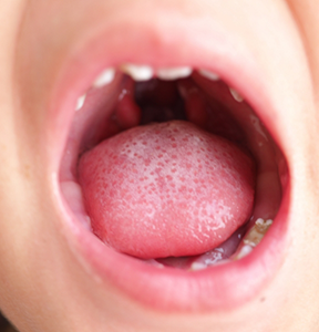 Close up of a wide open mouth with a cleft palate