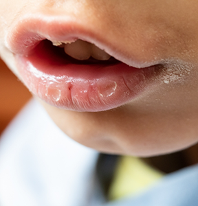Close up of a child's mouth with dry lips