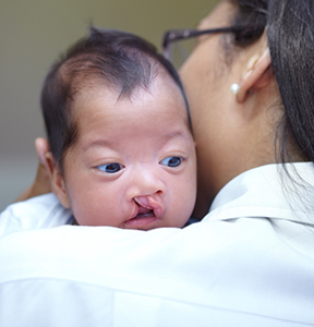 Mother holding her baby with a cleft lip