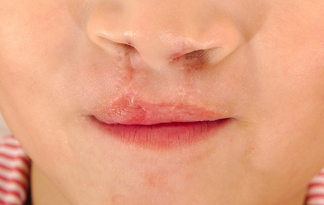 Close up of a mouth with a cleft lip