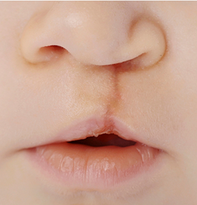 Close up of a small mouth with a cleft lip