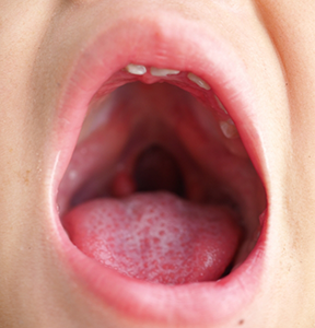 Close up of a wide open mouth with a cleft palate