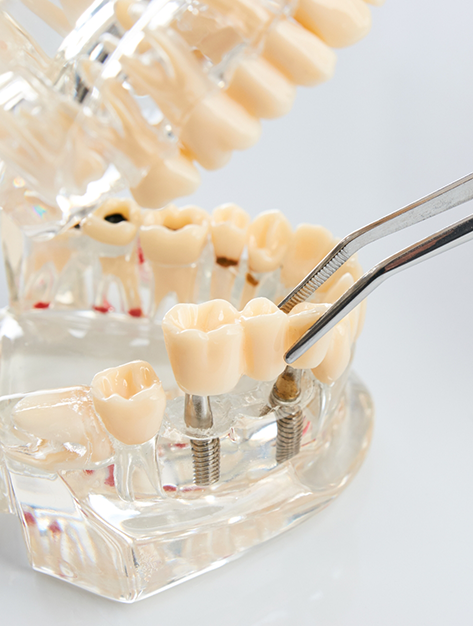 Tweezers placing a dental bridge on a model of two dental implants in Houston