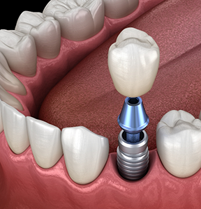 Illustration of a dental crown being placed over a dental implant