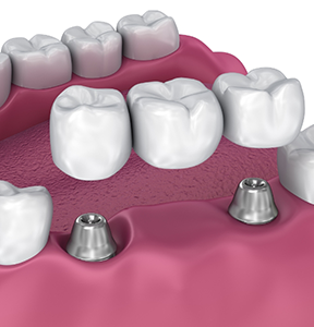 Illustration of a dental bridge being placed over two dental implants