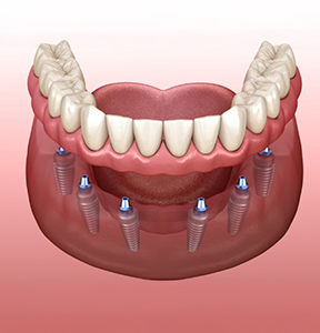 Illustration of a ful denture being placed over six dental implants