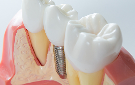 Model of a dental implant between two natural teeth