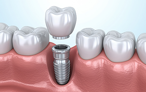 Model of a dental crown being placed over a dental implant in the lower jaw