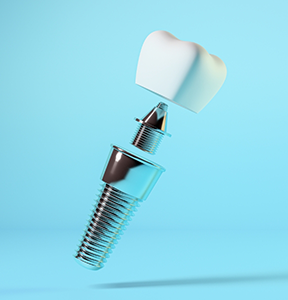 Model of a dental implant post, a crown, and the abutment connector piece