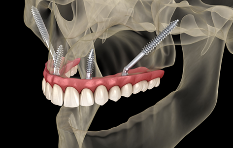 Illustration of a person with dental implants in their upper jaw extending back toward the cheekbones