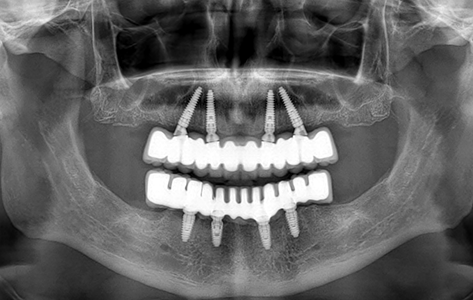 X ray of a patient with four upper dental implants pointing toward the center of the mouth