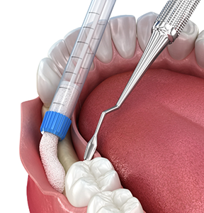 Illustration of bone grafting material being placed in the jawbone after a tooth extraction