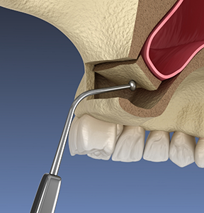 Illustration of a dental instrument gently lifting the sinus membrane