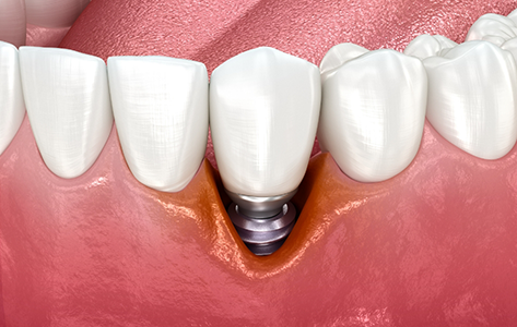 Illustration of the gum tissue around a dental implant receding