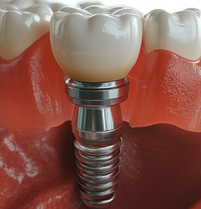 Illustration of a dental implant fusing with the lower jawbone