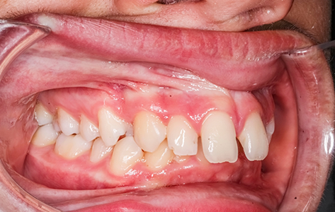 Close up of a mouth with an overbite