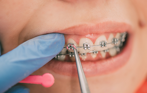 Orthodontist placing elastic bands on a patient's braces