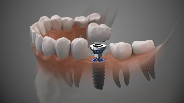 how-long-do-dental-implants-take-to-heal