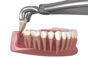 Illustration of forceps being used to remove a wisdom tooth