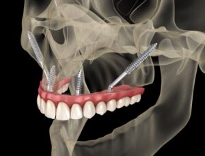 Digital image showing zygomatic implants