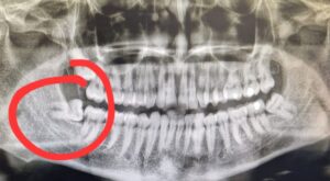 X-ray with red circle around impacted wisdom tooth