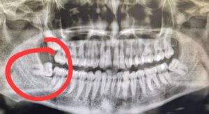 X-ray with sideways wisdom tooth circled in red 